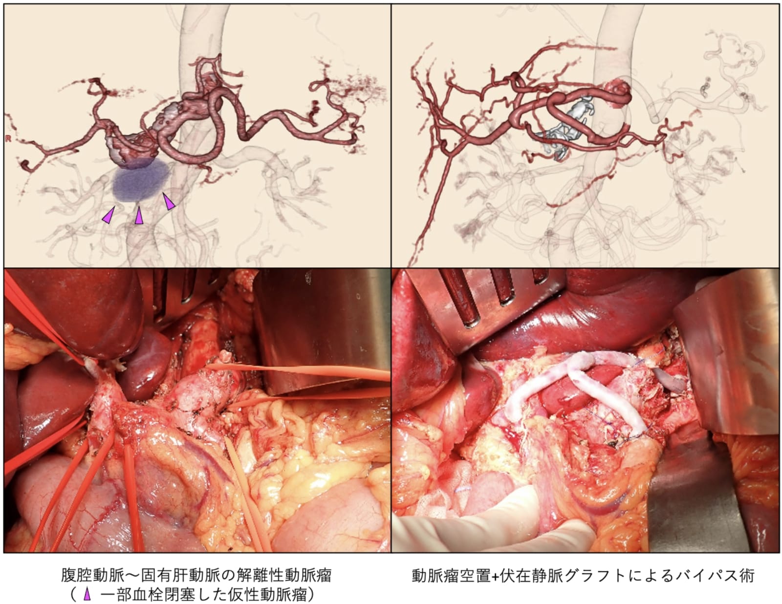 腹部内臓動脈瘤に対する手術